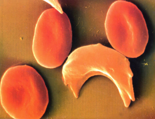 Sarlósejtes vérszegénység és a malária kapcsolata. Valóban evolúciós előny jelent?